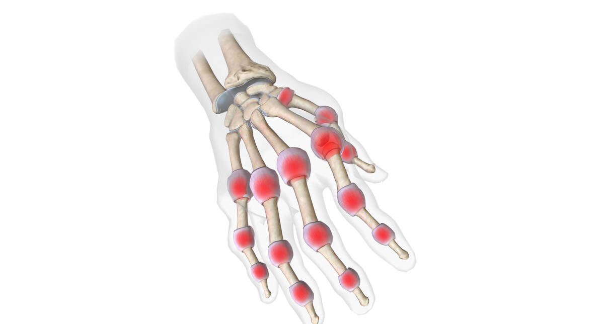 Viêm đa khớp dạng thấp