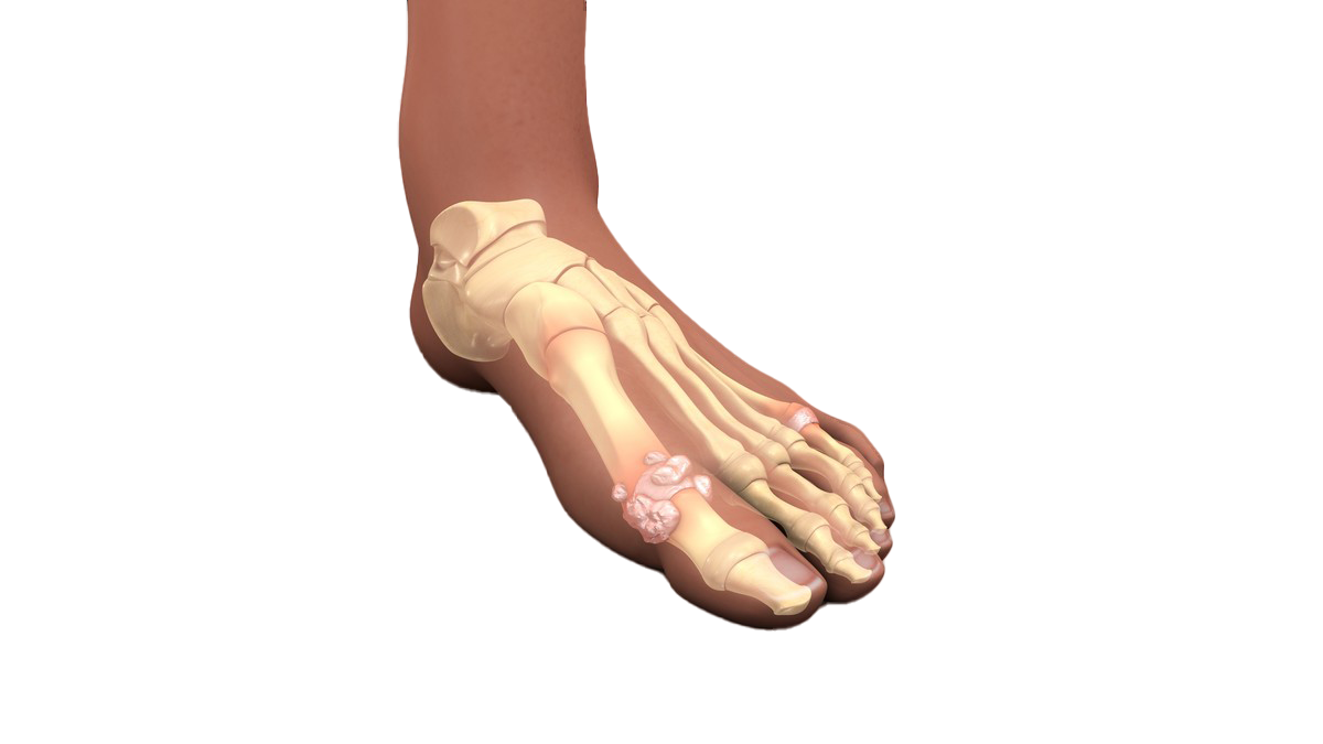 Gout (Bệnh gút)