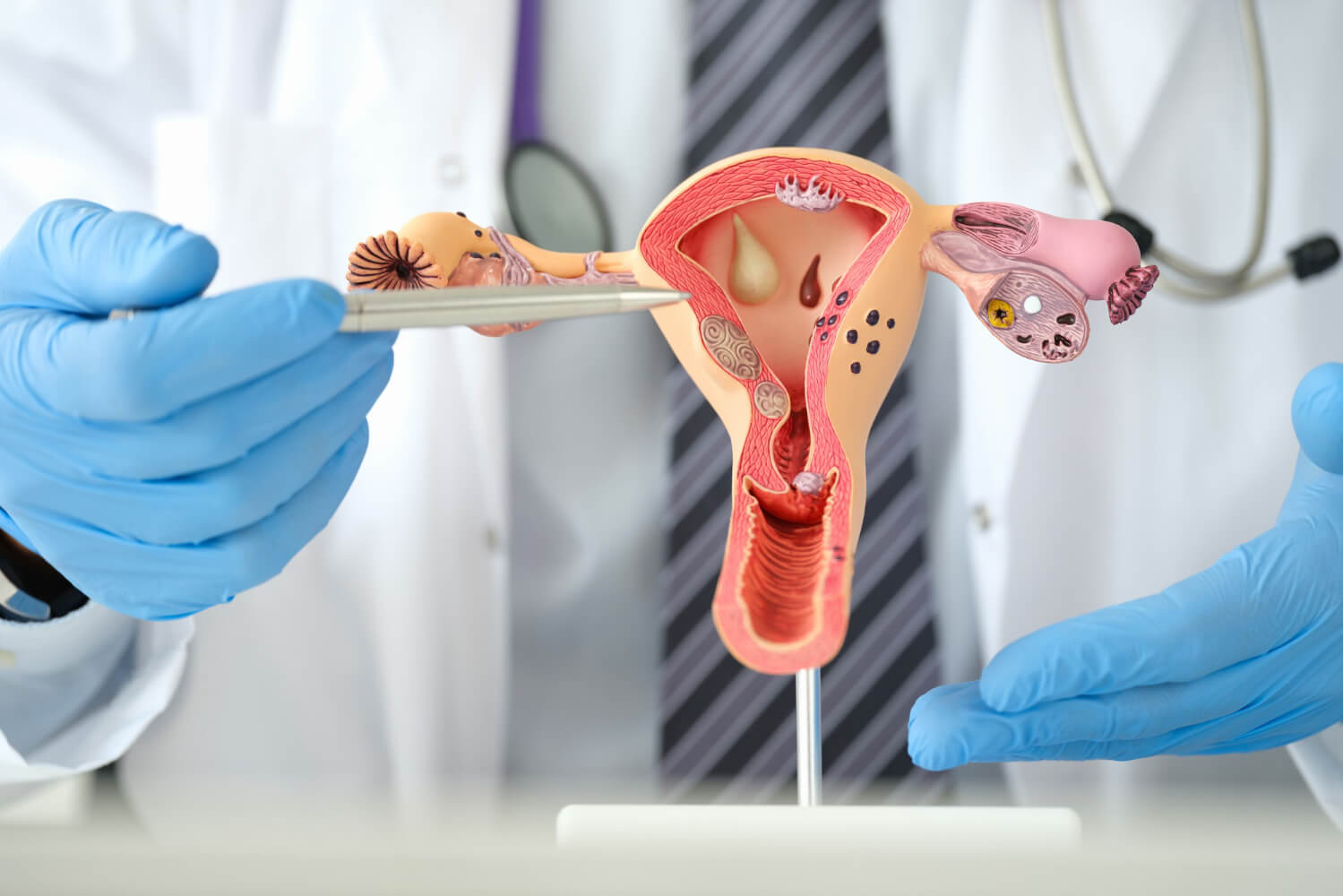 Buồng trứng đa nang (PCOS)