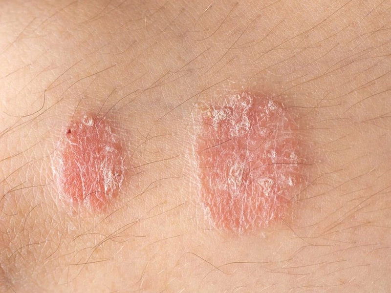 Hắc lào (nấm da)