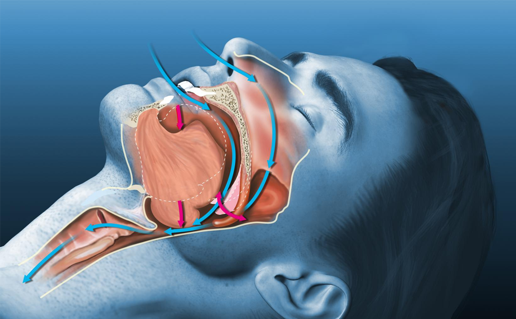Hội chứng ngưng thở khi ngủ (Sleep Apnea)