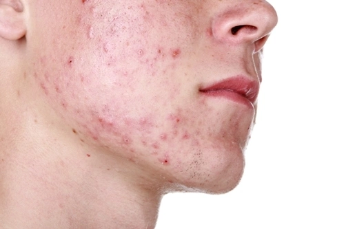 Mụn trứng cá