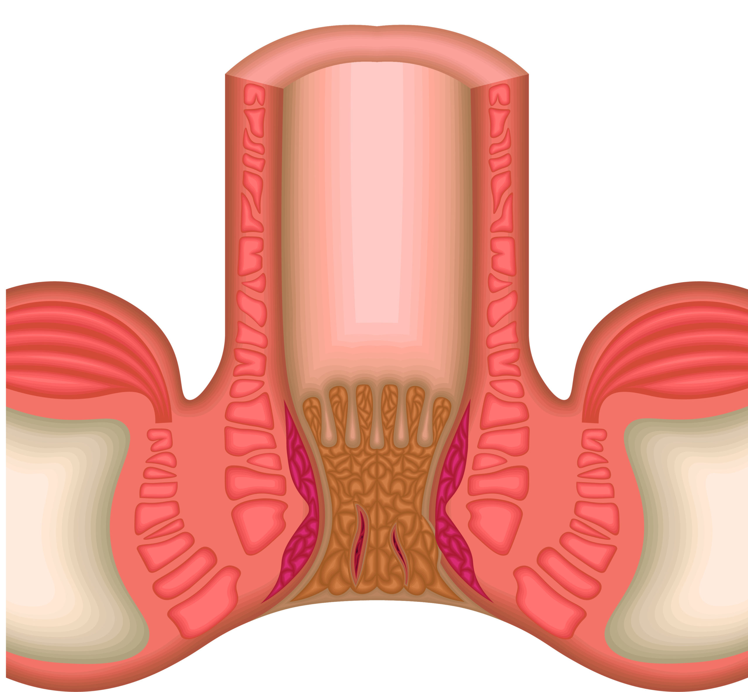 Nứt kẽ hậu môn