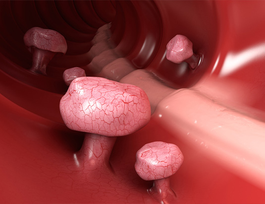Polyp trực tràng