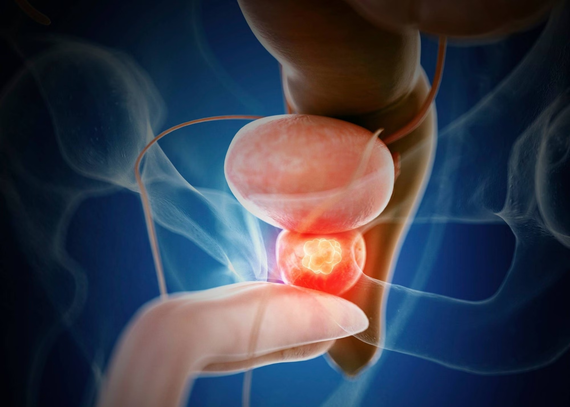 Viêm tuyến tiền liệt